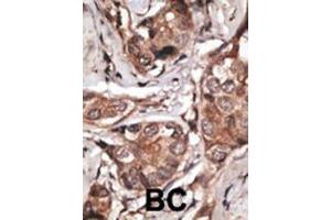 Formalin-fixed and paraffin-embedded human cancer tissue reacted with the primary antibody, which was peroxidase-conjugated to the secondary antibody, followed by DAB staining. (HTRA1 antibody  (C-Term))