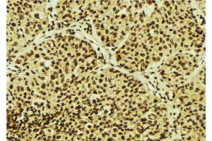 ABIN6274710 at 1/100 staining Human breast cancer tissue by IHC-P. (EFTUD2 antibody)