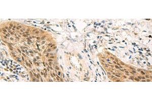 Immunohistochemistry of paraffin-embedded Human esophagus cancer tissue using PSME1 Polyclonal Antibody at dilution of 1:50(x200)