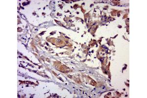 Paraformaldehyde-fixed, paraffin embedded human breast carcinoma, Antigen retrieval by boiling in sodium citrate buffer (pH6. (PRUNE antibody  (AA 201-300))