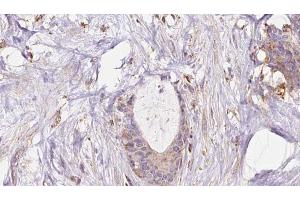 ABIN6273045 at 1/100 staining Human liver cancer tissue by IHC-P. (EXOC1 antibody  (N-Term))