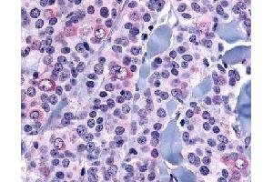 Immunohistochemical (Formalin/PFA-fixed paraffin-embedded sections) staining in human neoplastic cells with NANP polyclonal antibody . (NANP antibody)