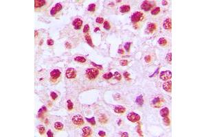 Immunohistochemical analysis of c-Rel staining in human breast cancer formalin fixed paraffin embedded tissue section.