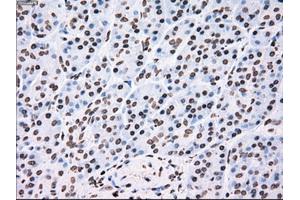 Immunohistochemical staining of paraffin-embedded Adenocarcinoma of colon tissue using anti-TYRO3mouse monoclonal antibody. (TYRO3 antibody)
