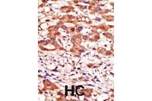 Formalin-fixed and paraffin-embedded human hepatocellular carcinoma tissue reacted with MGAT1 polyclonal antibody  , which was peroxidase-conjugated to the secondary antibody, followed by AEC staining . (MGAT1 antibody  (N-Term))