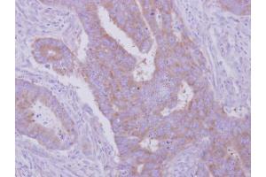 IHC-P Image Immunohistochemical analysis of paraffin-embedded human colon carcinoma, using HGS, antibody at 1:500 dilution.