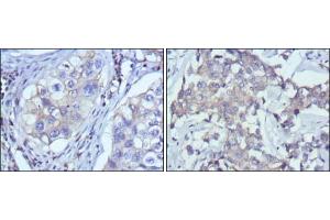 Immunohistochemical analysis of paraffin-embedded human lung cancer (left) and breast cancer (right) using RTN3 mouse mAb with DAB staining.