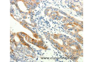 Immunohistochemistry of Human lung cancer using TRPA1 Polyclonal Antibody at dilution of 1:60