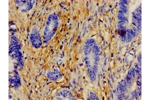 Immunohistochemistry of paraffin-embedded human colon cancer using ABIN7154609 at dilution of 1:100 (ERAL1 antibody  (AA 271-382))