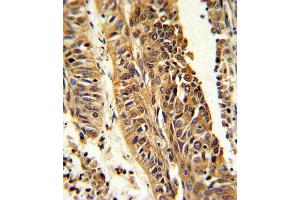 Formalin-fixed and paraffin-embedded human lung carcinoma reacted with CYP4B1 Antibody (Center) (ABIN652592 and ABIN2842397) , which was peroxidase-conjugated to the secondary antibody, followed by DAB staining. (CYP4B1 antibody  (AA 331-362))