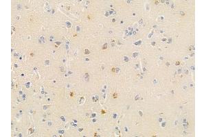 ABIN6266116 and ABIN6278648 at 1/100 staining human glioblastoma by IHC-P. (ZNF23 antibody  (Internal Region))
