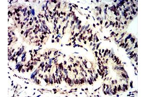 Immunohistochemical analysis of paraffin-embedded rectum cancer tissues using Phospho-4E-BP1 (Ser65) mouse mAb with DAB staining.