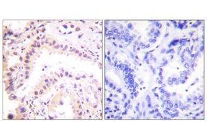 Immunohistochemical analysis of paraffin-embedded human lung carcinoma tissue using Cullin 2 antibody (ABIN5976372). (Cullin 2 antibody  (C-Term))