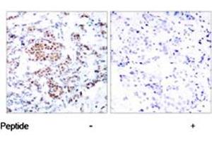 Immunohistochemical analysis of paraffin-embedded human breast carcinoma tissue using STAT5A polyclonal antibody . (STAT5A antibody)