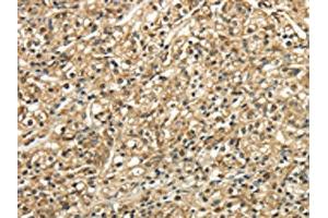 The image on the left is immunohistochemistry of paraffin-embedded Human prostate cancer tissue using ABIN7128049(TSC22D1 Antibody) at dilution 1/30, on the right is treated with fusion protein. (TSC22D1 antibody)