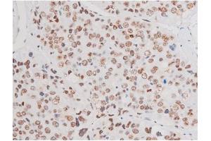 ABIN6267555 at 1/200 staining Human liver cancer tissue sections by IHC-P.