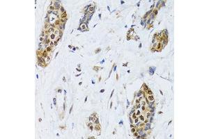 Immunohistochemistry of paraffin-embedded human breast cancer using CIRBP antibody (ABIN5973938) at dilution of 1/100 (40x lens).
