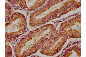 IHC image of ABIN7160647 diluted at 1:300 and staining in paraffin-embedded human endometrial cancer performed on a Leica BondTM system. (MTMR3 antibody  (AA 652-899))