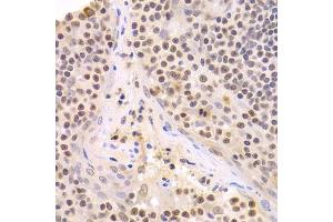 Immunohistochemistry of paraffin-embedded human amygdalitis using HMGB1 Antibody. (HMGB1 antibody  (AA 100-200))