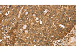 Immunohistochemistry of paraffin-embedded Human breast cancer using STARD5 Polyclonal Antibody at dilution of 1:40 (STARD5 antibody)