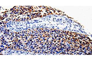 Immunohistochemistry of paraffin-embedded Human renal cancer tissue using COX10 Polyclonal Antibody at dilution 1:100