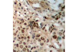Immunohistochemical analysis of JAK2 staining in human breast cancer formalin fixed paraffin embedded tissue section. (JAK2 antibody)