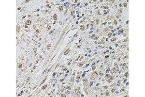 Immunohistochemistry of paraffin-embedded Human prostate cancer using SMARCC2 Polyclonal Antibody at dilution of 1:100 (40x lens).