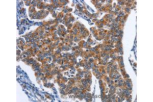 Immunohistochemistry of Human colon cancer using CADM3 Polyclonal Antibody at dilution of 1:40