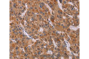 Immunohistochemistry of Human breast cancer using CALCA Polyclonal Antibody at dilution of 1:40 (CGRP antibody)