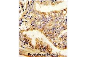 Formalin-fixed and paraffin-embedded human prostate carcinoma reacted with PUM2 Antibody , which was peroxidase-conjugated to the secondary antibody, followed by DAB staining. (PUM2 antibody  (AA 159-189))