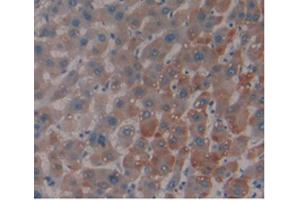 IHC-P analysis of Human Liver Cancer Tissue, with DAB staining. (MBL2 antibody  (AA 130-248))
