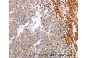 Immunohistochemistry of Human breast cancer using NRTN Polyclonal Antibody at dilution of 1:60