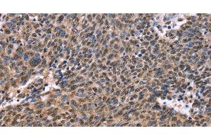 Immunohistochemistry of paraffin-embedded Human ovarian cancer using EVC2 Polyclonal Antibody at dilution of 1:40 (EVC2 antibody)