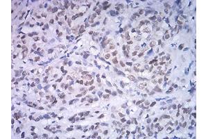Immunohistochemical analysis of paraffin-embedded breast cancer tissues using ATF4 mouse mAb with DAB staining. (ATF4 antibody  (AA 212-351))