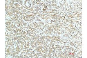 Immunohistochemical analysis of paraffin-embedded Human Breast Carrcinoma Tissue using a-actinin Mouse mAb diluted at 1:200. (ACTN1 antibody)