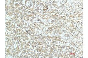 Immunohistochemical analysis of paraffin-embedded Human Breast Carrcinoma Tissue using a-actinin Mouse mAb diluted at 1:200.