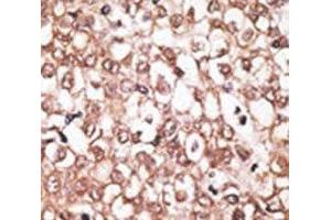 IHC analysis of FFPE human hepatocarcinoma tissue stained with the ABCB11 antibody