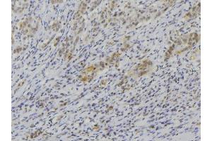 ABIN6272589 at 1/100 staining Human lung cancer tissue by IHC-P. (IL1F9 antibody  (N-Term))