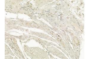ABIN6256874 and ABIN6274505 at 1/100 staining human esophageal carcinoma by IHC-P. (XRN2 antibody  (N-Term))