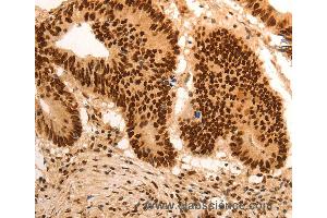 Immunohistochemistry of Human gastic cancer using E2F7 Polyclonal Antibody at dilution of 1:60
