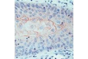 Formalin-fixed, paraffin-embedded human squamous cell carcinoma stained with CD44v4 Ab using peroxidase-conjugate and AEC chromogen. (CD44 antibody)