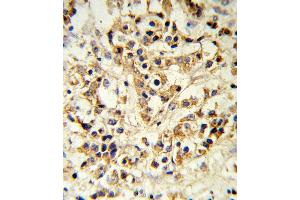FGFR1 Antibody IHC analysis in formalin fixed and paraffin embedded human breast carcinoma followed by peroxidase conjugation of the secondary antibody and DAB staining. (FGFR1 antibody)