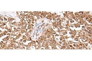 Immunohistochemistry of paraffin-embedded Human ovarian cancer tissue using USP16 Polyclonal Antibody at dilution of 1:25(x200) (USP16 antibody)