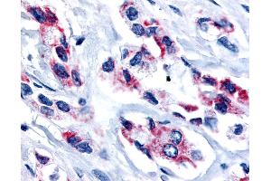 Anti-ESRRB / ERR Beta antibody IHC of human Prostate, Carcinoma. (ESRRB antibody  (Internal Region))