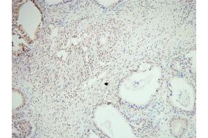 SNAI2 Antibody(ABIN6276471) staining human ovarian cancer tissue sections by IHC-f at 1:200.
