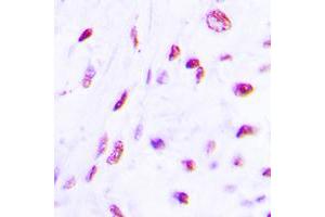 Immunohistochemical analysis of C/EBP beta (pT235) staining in human lung cancer formalin fixed paraffin embedded tissue section. (CEBPB antibody  (pSer235))