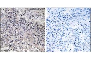 Immunohistochemistry analysis of paraffin-embedded human lung carcinoma tissue, using C1QC Antibody. (C1QC antibody  (AA 81-130))
