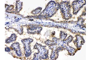 PDE5A was detected in paraffin-embedded sections of human thyroid cancer tissues using rabbit anti- PDE5A Antigen Affinity purified polyclonal antibody (Catalog # ) at 1 µg/mL. (PDE5A antibody  (N-Term))