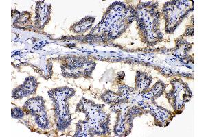 PDE5A was detected in paraffin-embedded sections of human thyroid cancer tissues using rabbit anti- PDE5A Antigen Affinity purified polyclonal antibody (Catalog # ) at 1 µg/mL.