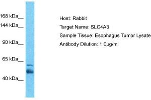 Host: Rabbit Target Name: SLC4A3 Sample Tissue: Human Esophagus Tumor Antibody Dilution: 1ug/ml (SLC4A3 antibody  (N-Term))